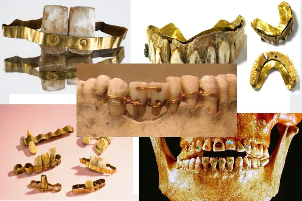 أسنان ذهبية