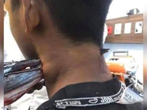 سمكة إبرة تقفز من المياه وتخترق رقبة صبي إندونيسي