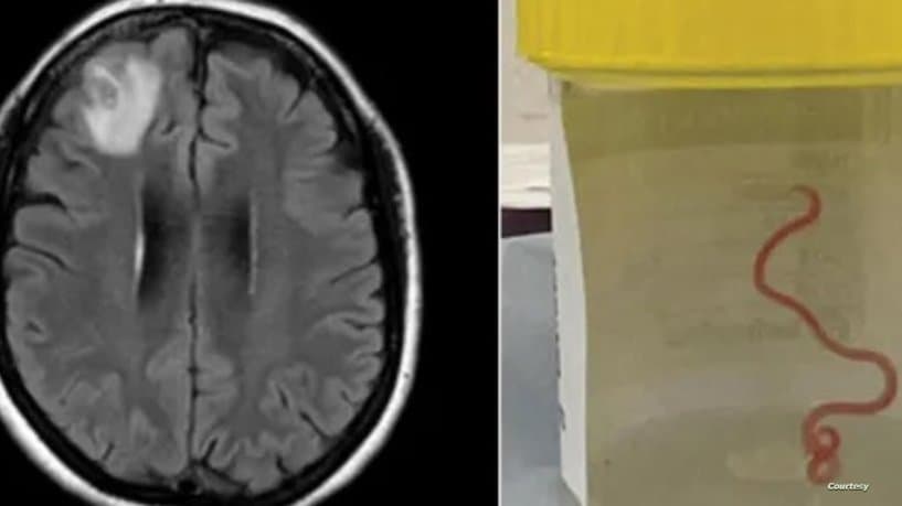 اكتشاف أول حالة بالعالم لـ”دودة ثعابين” بدماغ مريضة