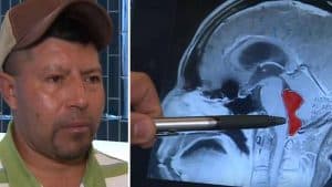 دودة تسكن دماغ رجل 10 سنوات.. والأطباء في ذهول